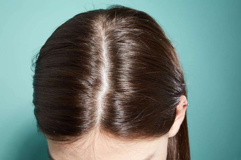Cara Mengatasi Rambut Tipis Tanpa Pergi ke Dokter